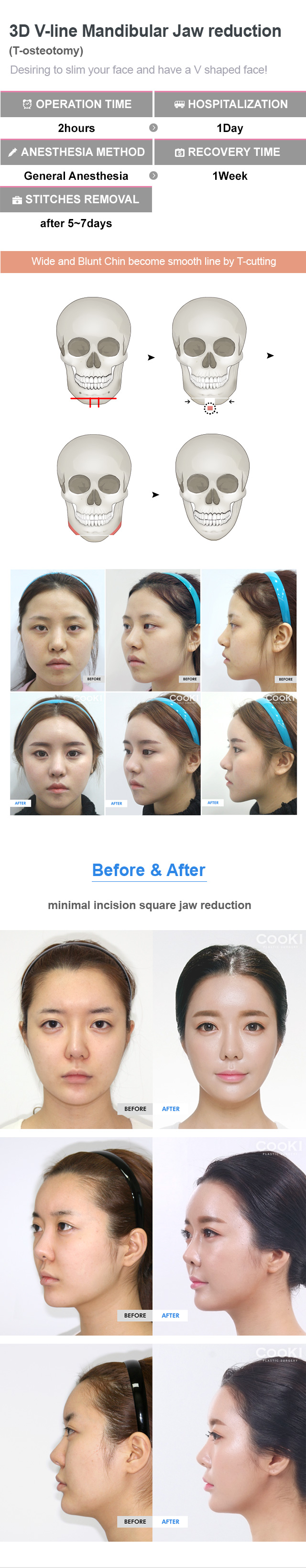 Power V Contouring, Double Chin Surgery, Fat Graft Cheeks, Double Chin  Surgery Before And After In Seoul Korea